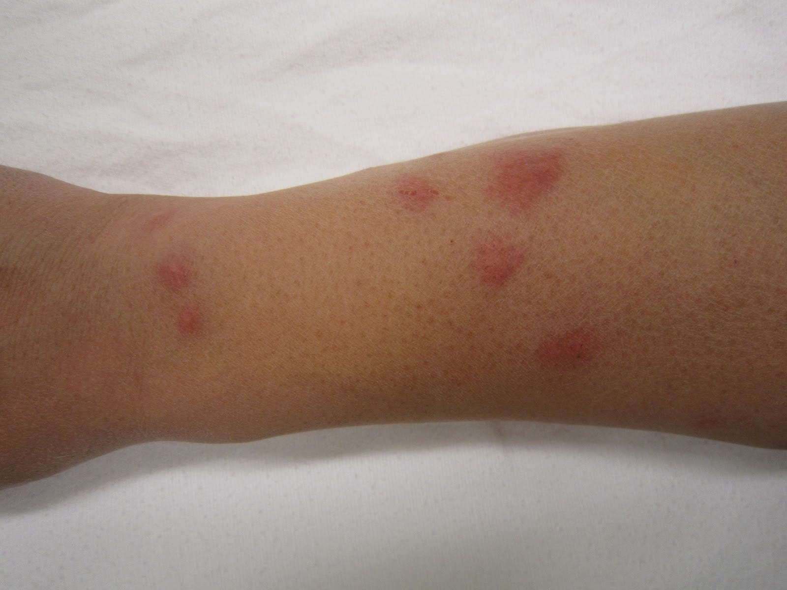 What Do Roach Bites Look Like?
